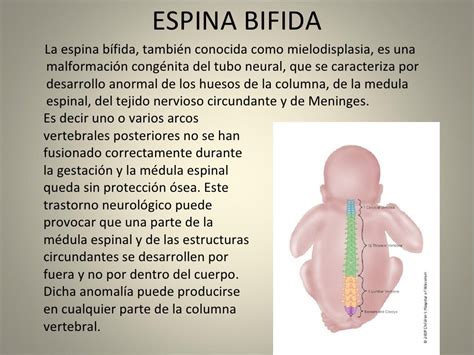 espina bifida definicion